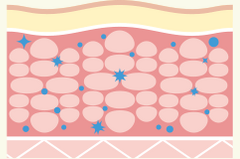 cavitation_01