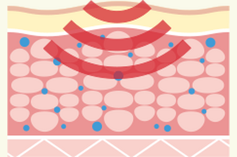 cavitation_02