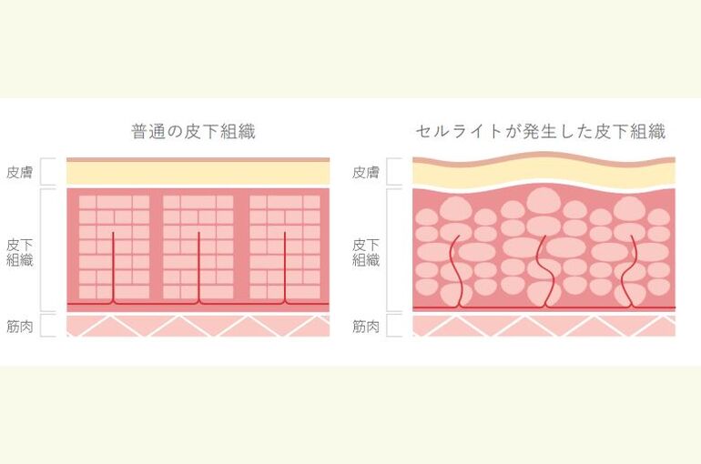 セルライト発生